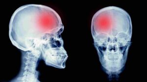 How Can Bicycle Accidents Lead to Traumatic Brain Injury?